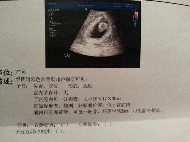 几个月可以查出来胎心 a20c5777b394452882a2054d85548d00.jpeg