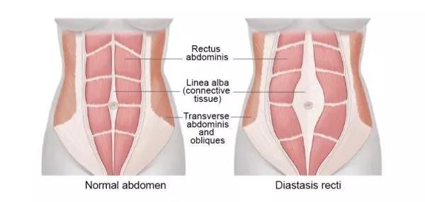 子宫会使腹壁扩张延伸,两侧的腹直肌会从腹中线——也就是腹白线的