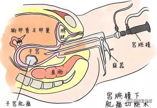 健康丨宫腔镜检查知多少