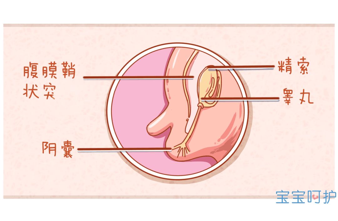 「宝宝呵护」宝宝隐私部位有个“包”，竟会影响宝宝的生育能力？