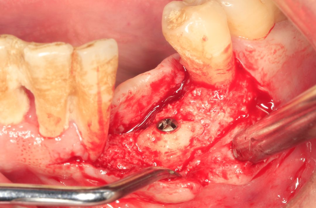 牙周炎患者埋伏牙拔除与牙槽嵴重建及种植修复一例 | 海奥种植长廊
