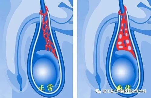 阴囊也长蚯蚓原来真相是这样