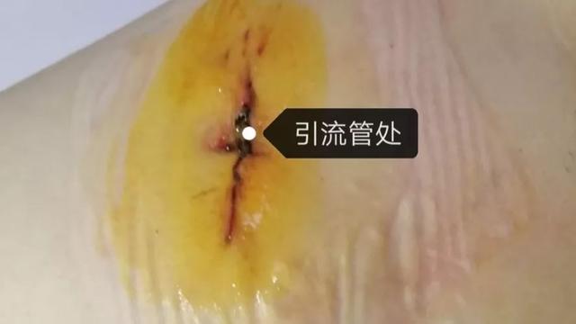 传统胸腔镜下手术方法有"三孔法","两孔法",加上术后引流伤口不易愈合