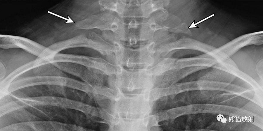 发育性肋骨融合:可能累及肋骨的任何部分;融合可能改变胸部生物力学