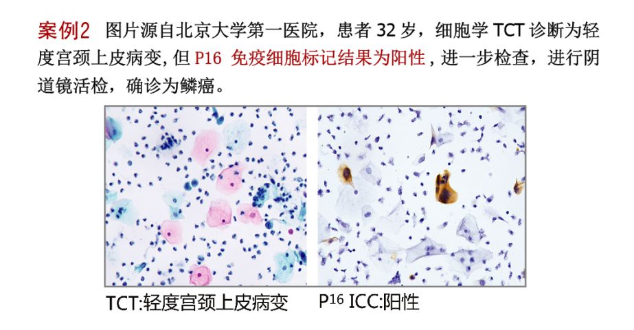 "p16icc tct"联合检测宫颈细胞学设备和技术,可以大大提高阳性宫颈