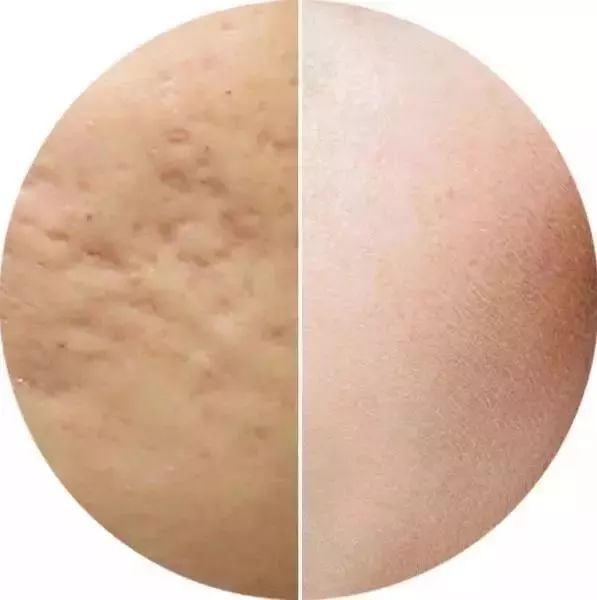 粉刺脓包型痤疮治疗 b8dec4ed56464e7f9a8606a045615a09.jpeg