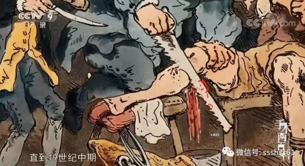 败血症而死亡,而当时观看手术过程的一名观众也因为受不了场面的血腥