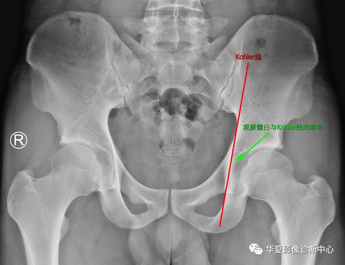 16,power角:骨盆正位片,过两侧髂前上棘做一水平线,再做股骨颈骨折的
