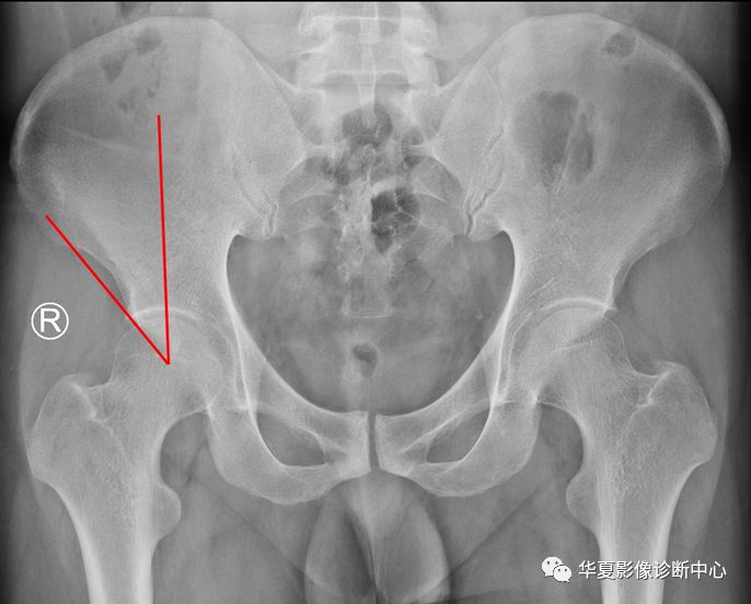 13,髋臼深度:骨盆正位片,耻骨联合上缘与髋臼外上缘连线至髋臼底的最