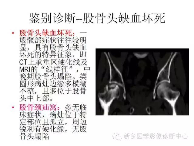 股骨颈疝窝诊断容易,但要记得和这几个疾病鉴别