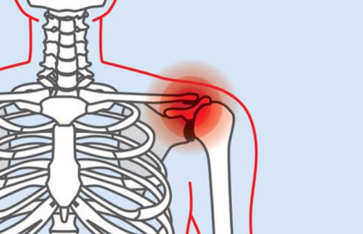 肩周炎治疗主要需要患者主动运动,肩袖损伤患者若主动运动撞击