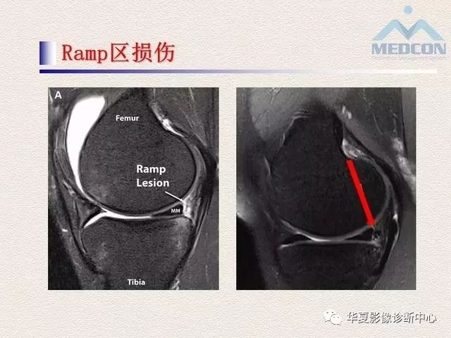 半月板常见病变及正常变异的mri诊断