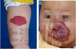 名医专访丨上海第九人民医院陈辉血管瘤和血管畸形的诊断和治疗