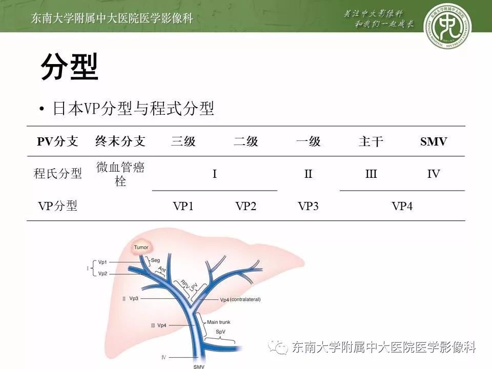 肝癌合并门静脉癌栓