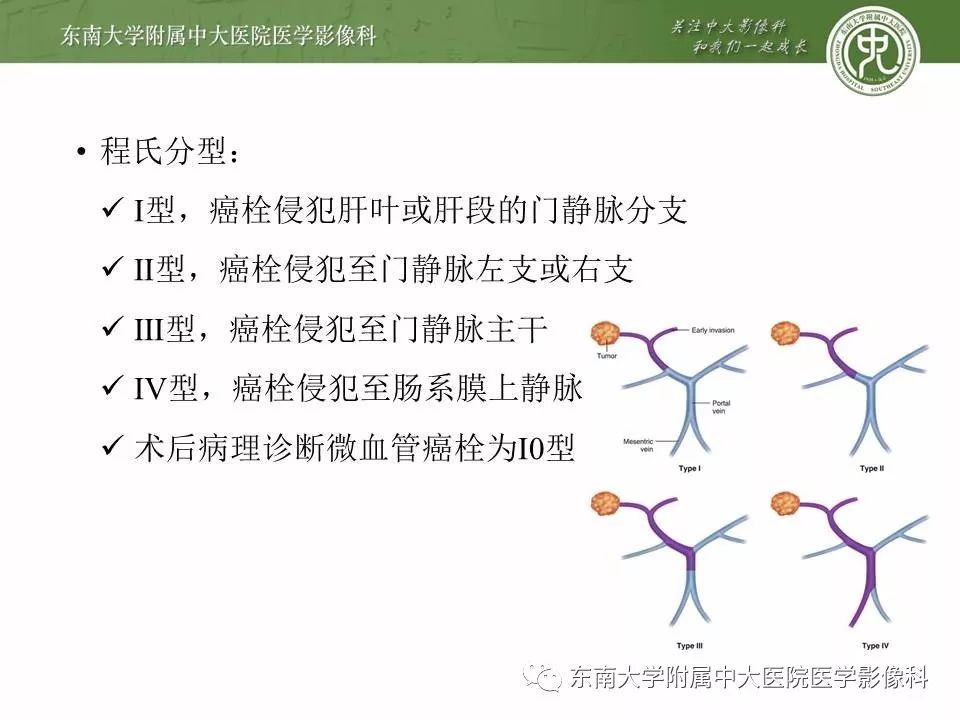 肝癌合并门静脉癌栓