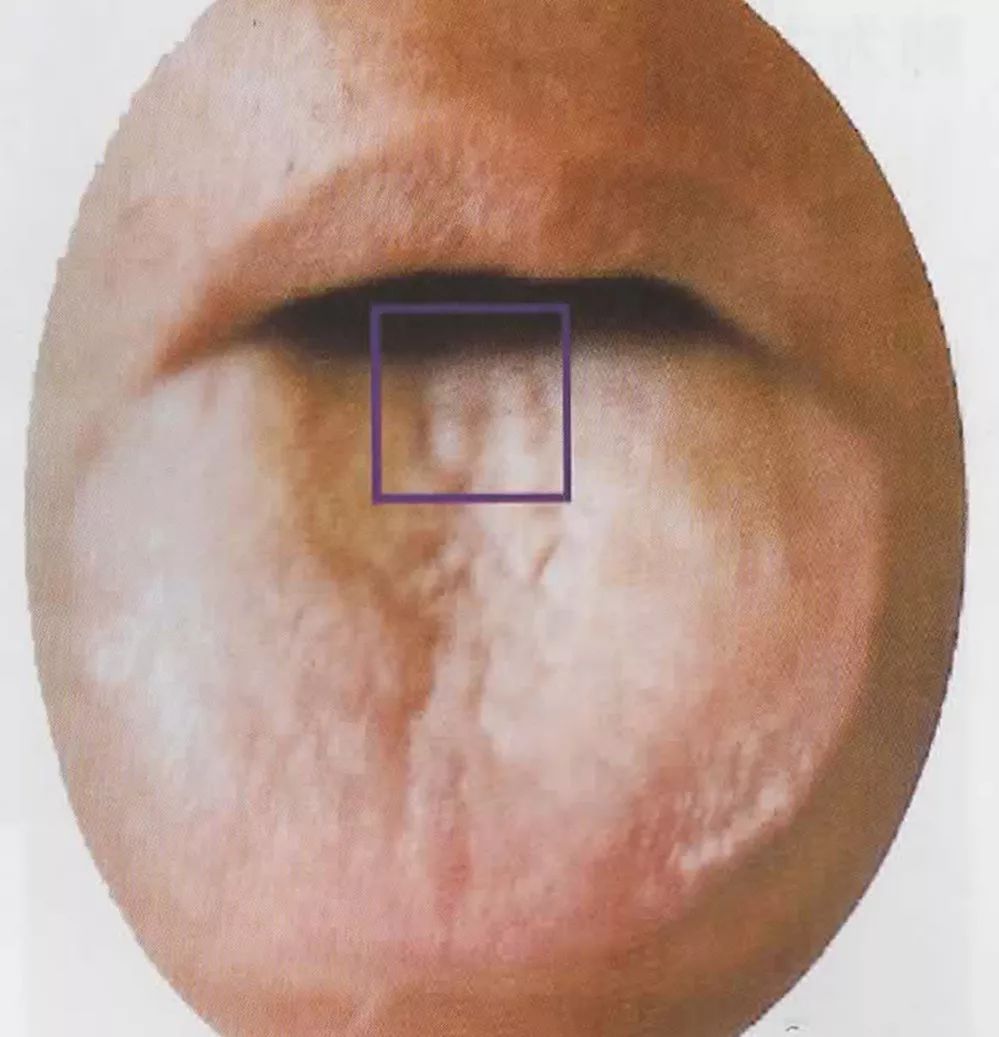 舌面后1/3中部(即舌"九分区"的2区)为心脏疾病的反应点.