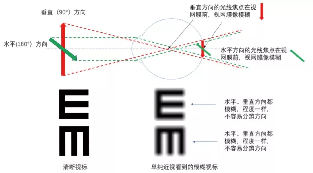 近视300度看到的画面,300度近视效果图 散光的原因大咖课堂丨梅颖教授谈"散光300度视力08需要配戴眼镜