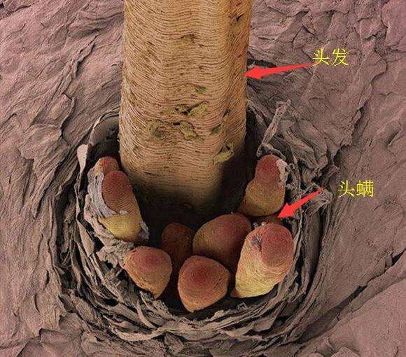 有人说头螨是脱发的元凶之一,你了解吗?