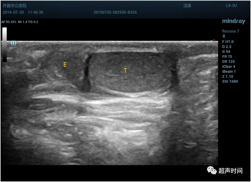 11 岁男孩,超声检查发现了第三个睾丸