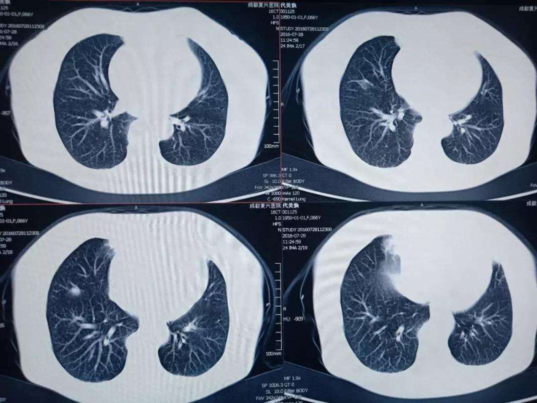 2016年7月28日,ct片显示代阿姨肺部有结节