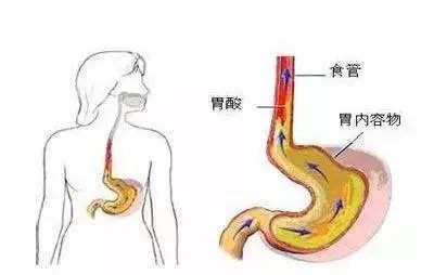 咽炎的原理_化橘红治疗咽炎咳嗽的原理