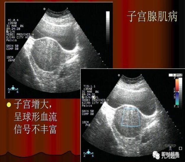 三,子宫肥大由于多育多产,子宫炎症引起子宫肌层结缔组织增生,造成