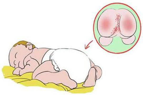 嬰兒紅屁股如何護理 嬰兒紅屁股怎麼預防