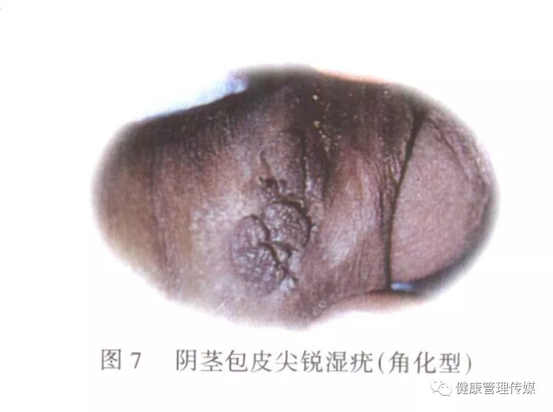 hpv病毒会一直存在身体里吗 89ef785eb6254249a76d05ddf365af8e.jpeg