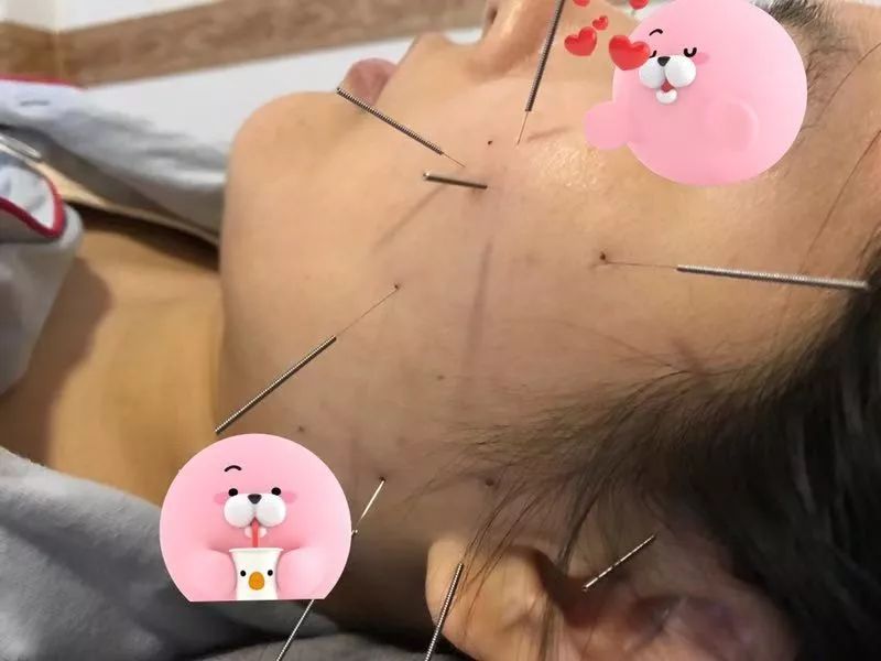 颊针疗法|颊针产后系列的治疗—通乳消结,保证母乳喂养_乳腺