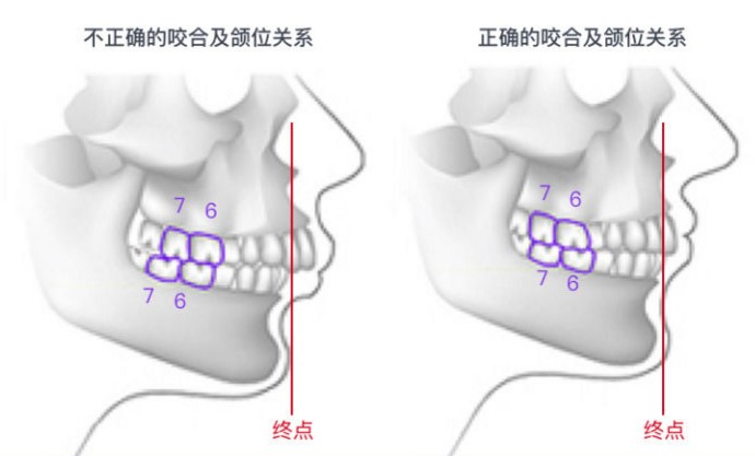 嘴窄怎么办