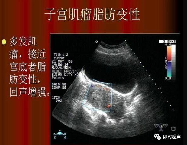 子宫肌层病变超声诊断_肌瘤