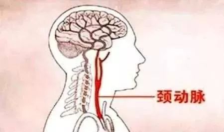 三分之一的人有颈动脉斑块 五件小事会让病情恶化 血管