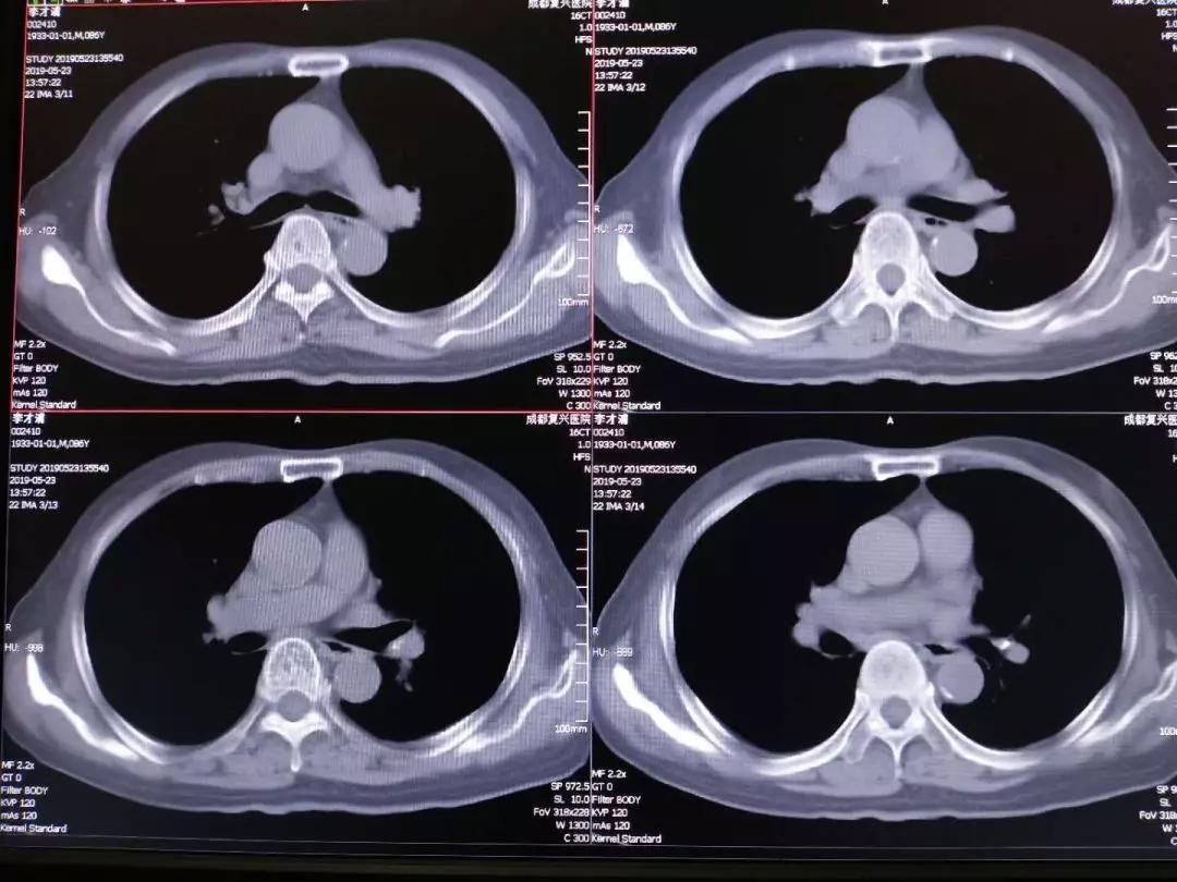 发展，甚至肺上的肿瘤已经缩小了百分之四十，于是在2019年1月3日出院了。在进行了四个疗程的治疗后，