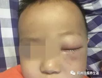 杭州日报养生道@爷爷的一个疏忽，差点毁了2岁宝宝的眼睛！眼科医生：还有许多“稀奇古怪”的病例