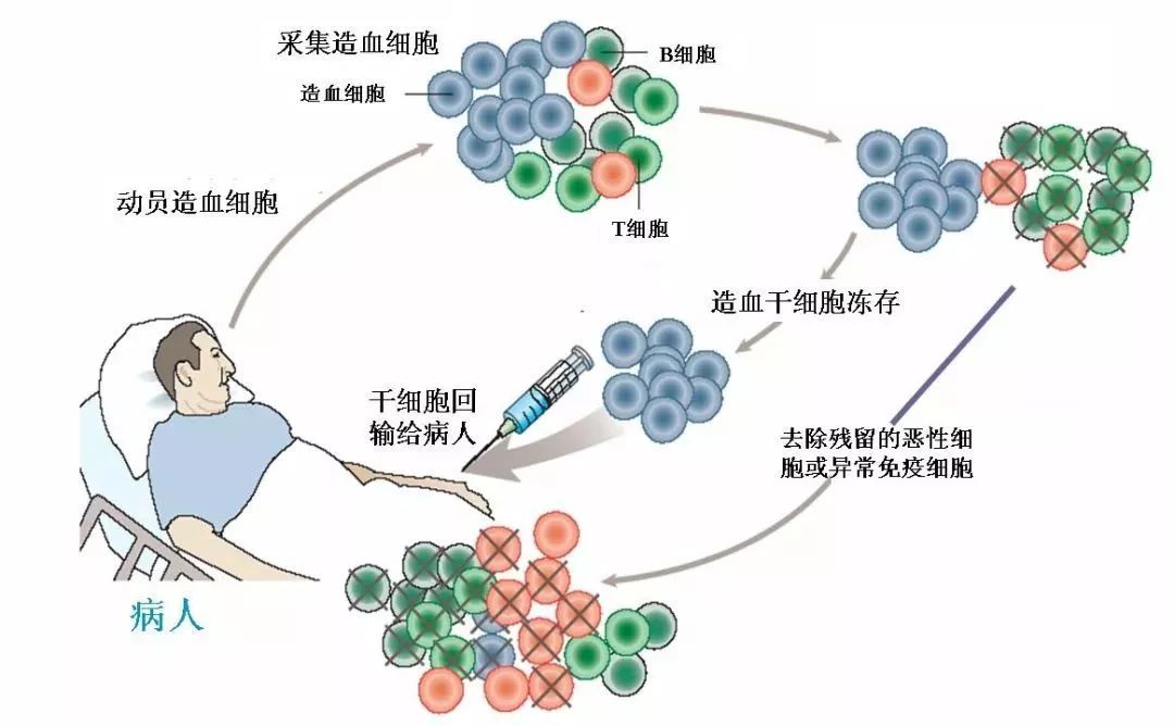 造血干细胞移植 是利用造血干细胞具有多向分化发育能力的一种治疗