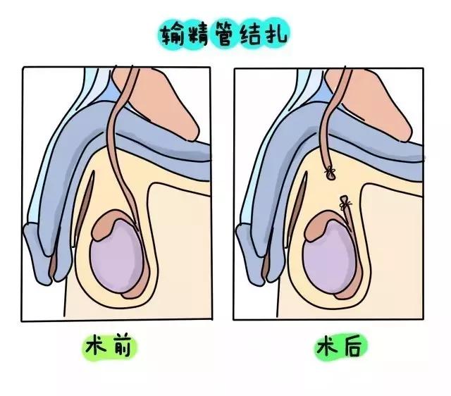 结扎不是阉割,还是完整的汉子,男同胞们不用紧张,只是将输精管剪断,再