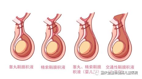 4种小儿鞘膜积液1.精索鞘膜积液的包块通常出现在睾丸上方的位置、卵圆形