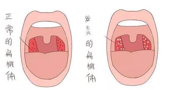 过敏扁桃体发炎怎么办