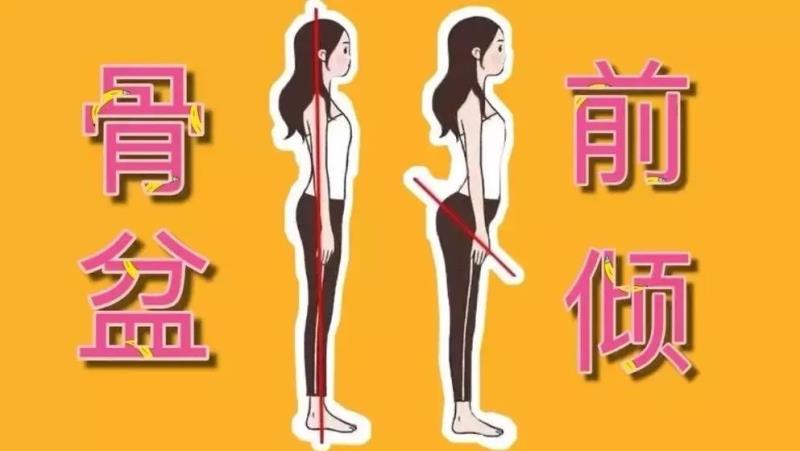 骨盆前倾是指骨盆向前病态的偏移,造成腰椎不正常的生理前凸,骨盆前倾