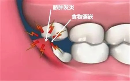 急性牙疼怎么办