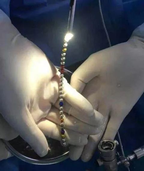 以往,这类异物要想取出来,需在患者肚皮上做开刀手术.