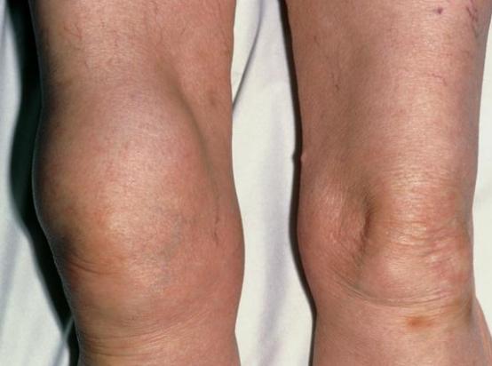 膝盖滑膜炎怎么治好的 b1944f3c1e324eb98923fbbb1a1a1d69.jpeg