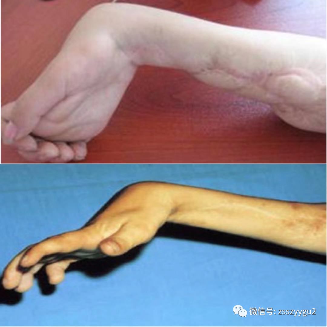 轻者仅手指不能伸直,严重者手指及腕关节均呈屈曲僵硬,套式感觉麻痹