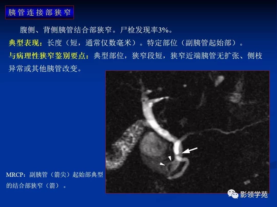 mrcp显示伴囊肿的背胰管(箭,腹胰管未显示.