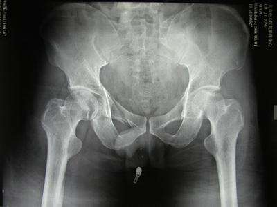 骨盆痛是什么症状 c58c2eaa3eaa46b281233025b3ecf4a6.jpeg