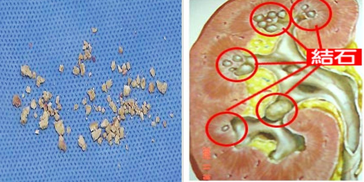 泥沙型肾结石最佳治疗方法?治疗上一定要注意这些!