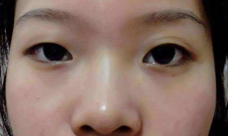 埋线双眼皮效果不好可以恢复吗 f928ff488bee4d3e9c2eca9f8908b578.jpeg