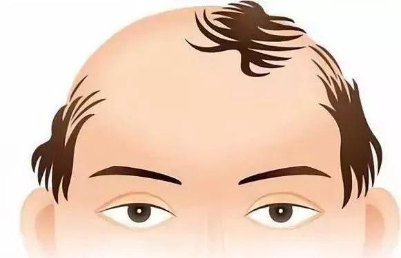 脱发严重是什么样的 36155be1f09f4d17a0b1874c61ad6950.jpeg