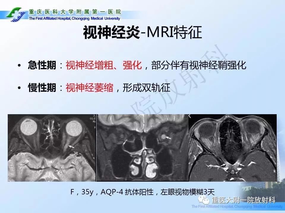 视神经脊髓炎临床及mri特征