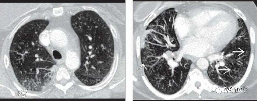 病毒性肺炎丨ct表现,诊断要点